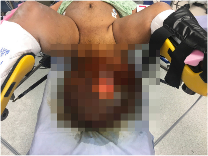  This graphic image shows the man's swollen scrotum when he arrived at hospital